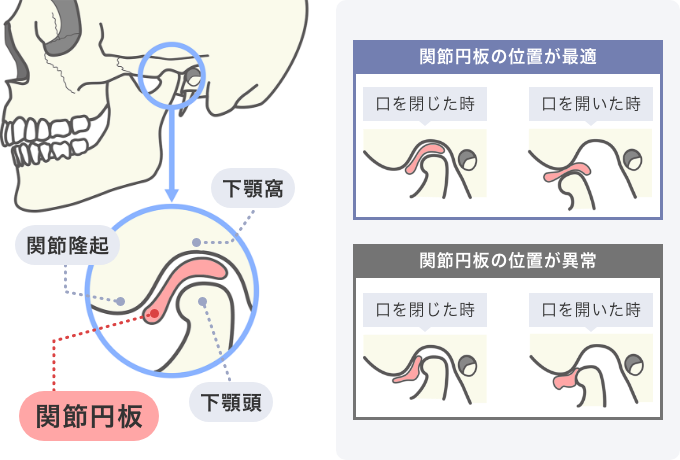 顎の関節の仕組みと動き（関節円板の位置が最適な場合と異常な場合の、口を閉じた時・開いた時の比較）