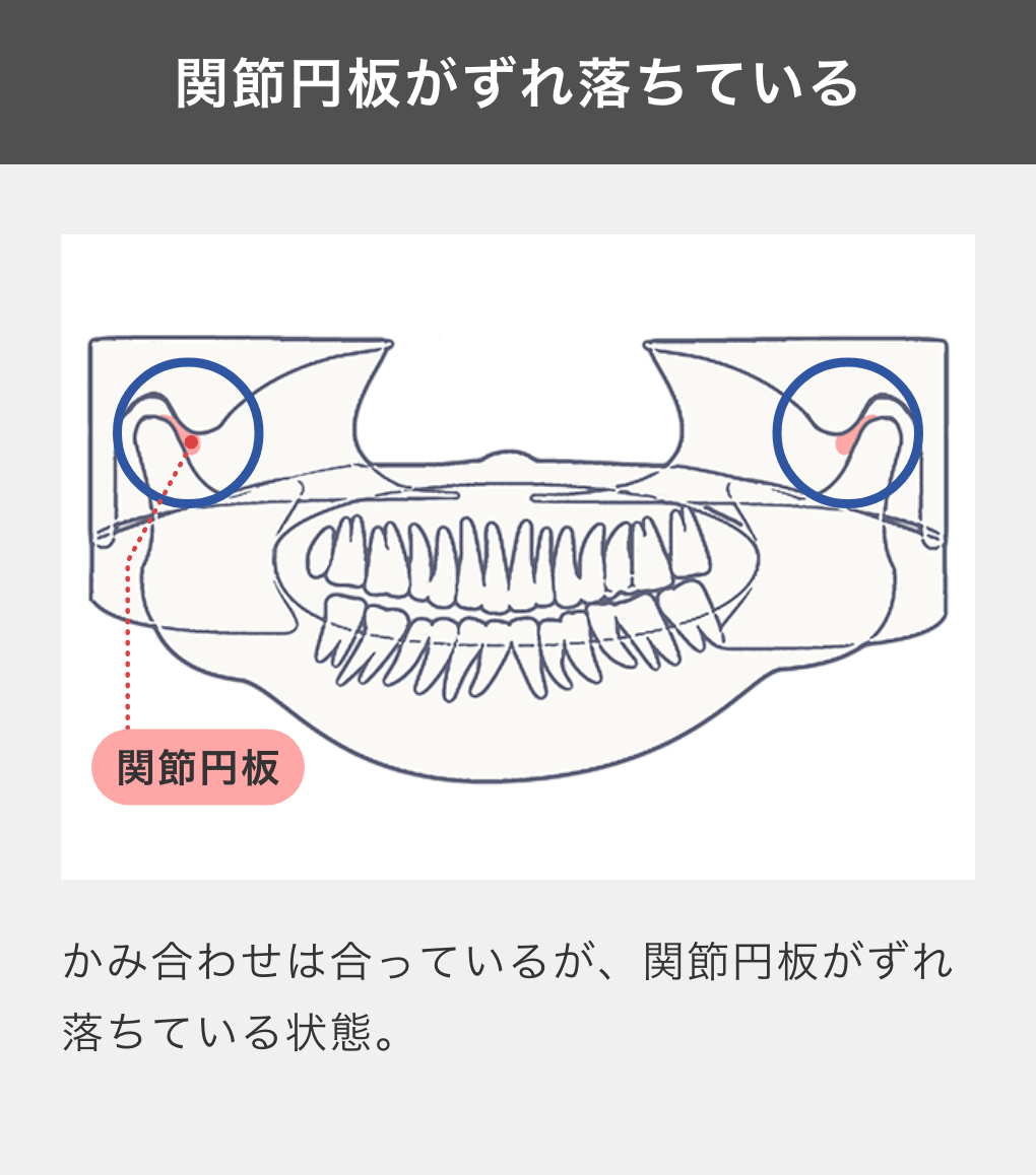 関節円板がずれ落ちている：かみ合わせは合っているが、関節円板がずれ落ちている状態