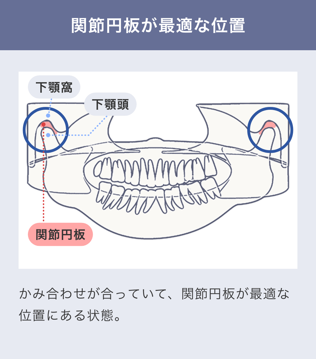 関節円板が最適な位置：かみ合わせが合っていて、関節円板が最適な位置にある状態
